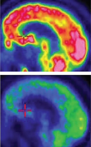 A positron emission tomography (PET) scan of the brain of an unconscious patient (<em>bottom</em>) shows low levels of activity. A dose of the drug zolpidem greatly increases activity in many parts of the brain (<em>top</em>), as indicated by the yellow, orange, and red areas. <strong>Photograph courtesy of Weill Cornell Medical College.</strong>