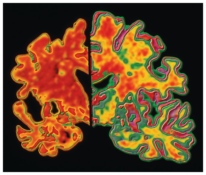 Medical imaging shows that the brain of a patient with Alzheimer’s disease (<em>left</em>) differs from a healthy brain (<em>right</em>) not only in volume but also in the level of activity in many specific areas. <strong>A. Pakieka/Science Source.</strong>