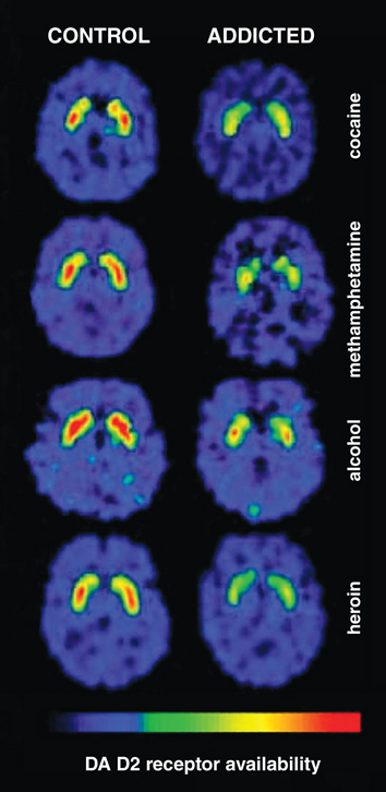 Neurobiologic Advances from the Brain Disease Model of Addiction